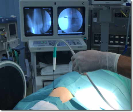 Figure1, Fluoroscopically-guided Probe insertion